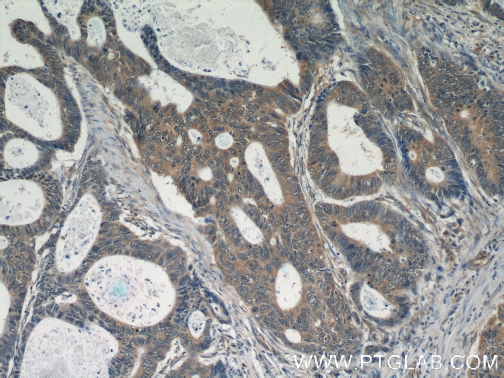 Immunohistochemistry (IHC) staining of human colon cancer tissue using FER Polyclonal antibody (25287-1-AP)