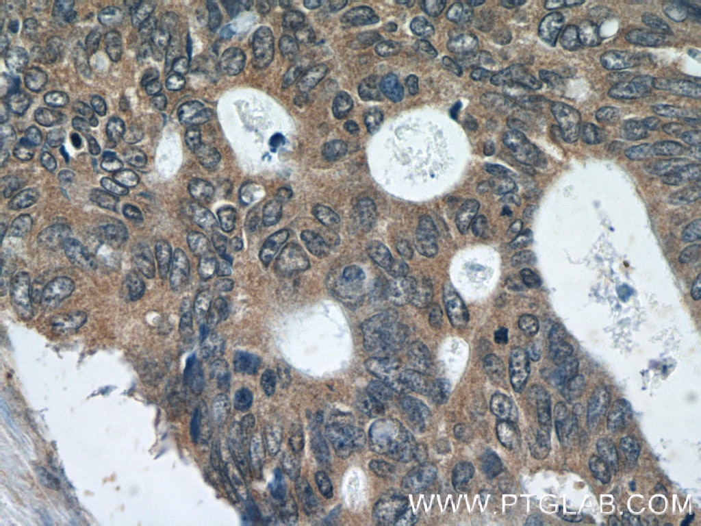 Immunohistochemistry (IHC) staining of human colon cancer tissue using FER Polyclonal antibody (25287-1-AP)
