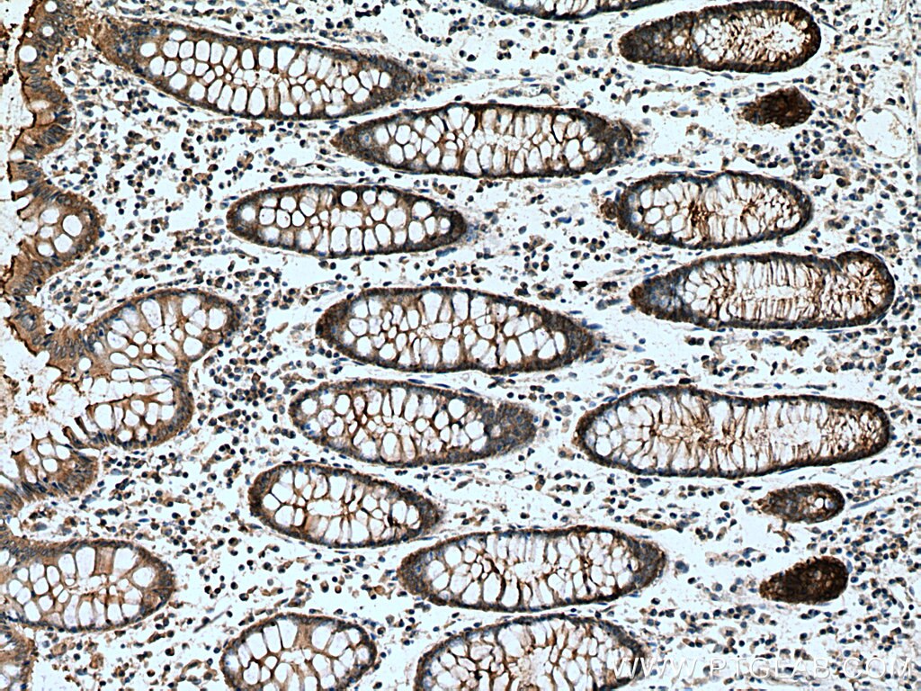 Immunohistochemistry (IHC) staining of human colon cancer tissue using Kindlin 1 Polyclonal antibody (22215-1-AP)