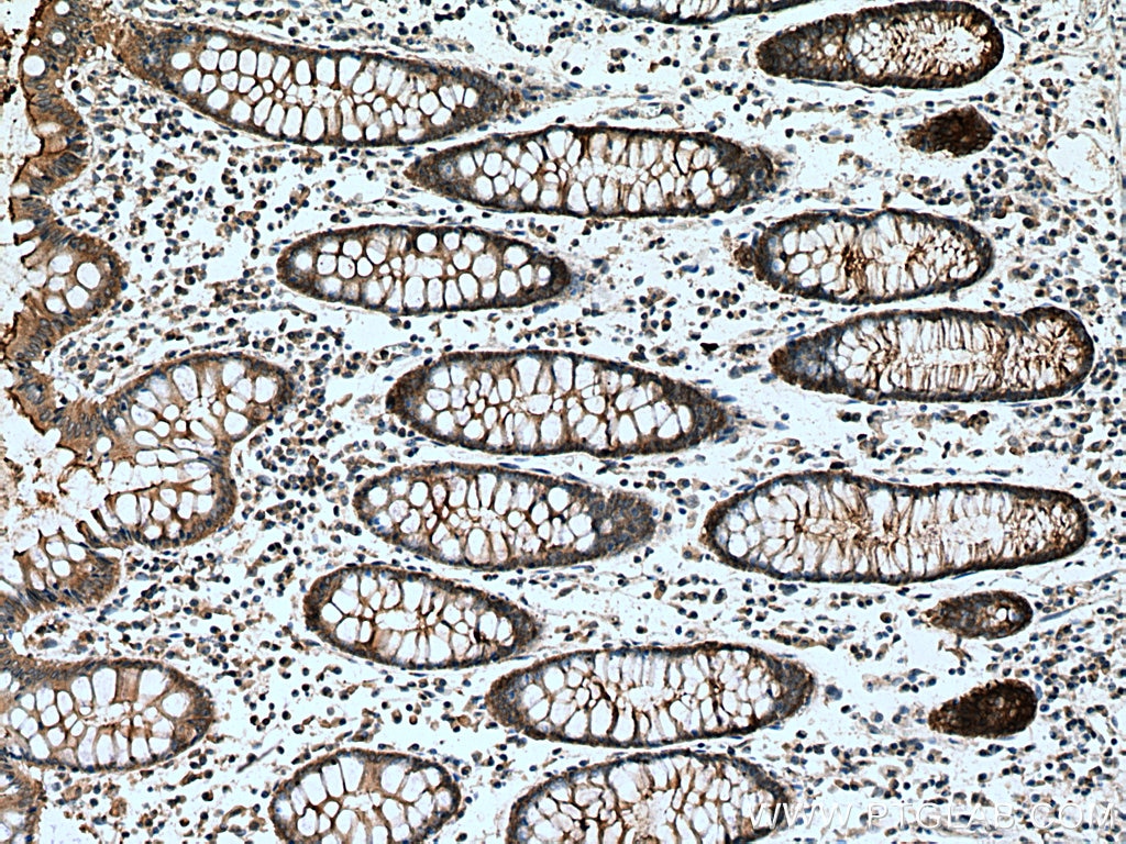 IHC staining of human colon cancer using 22215-1-AP