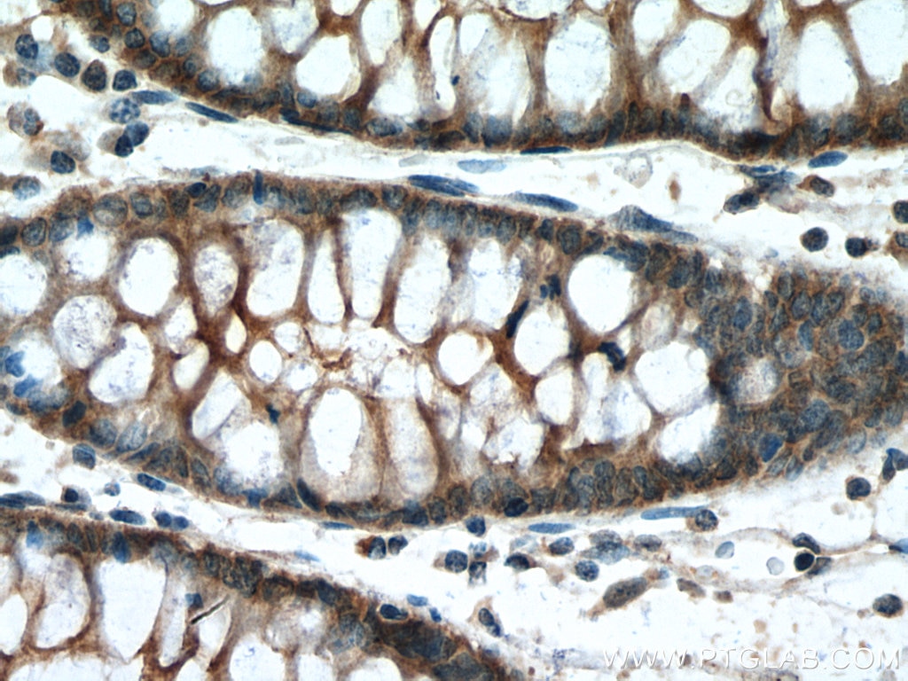 IHC staining of human colon cancer using 22215-1-AP
