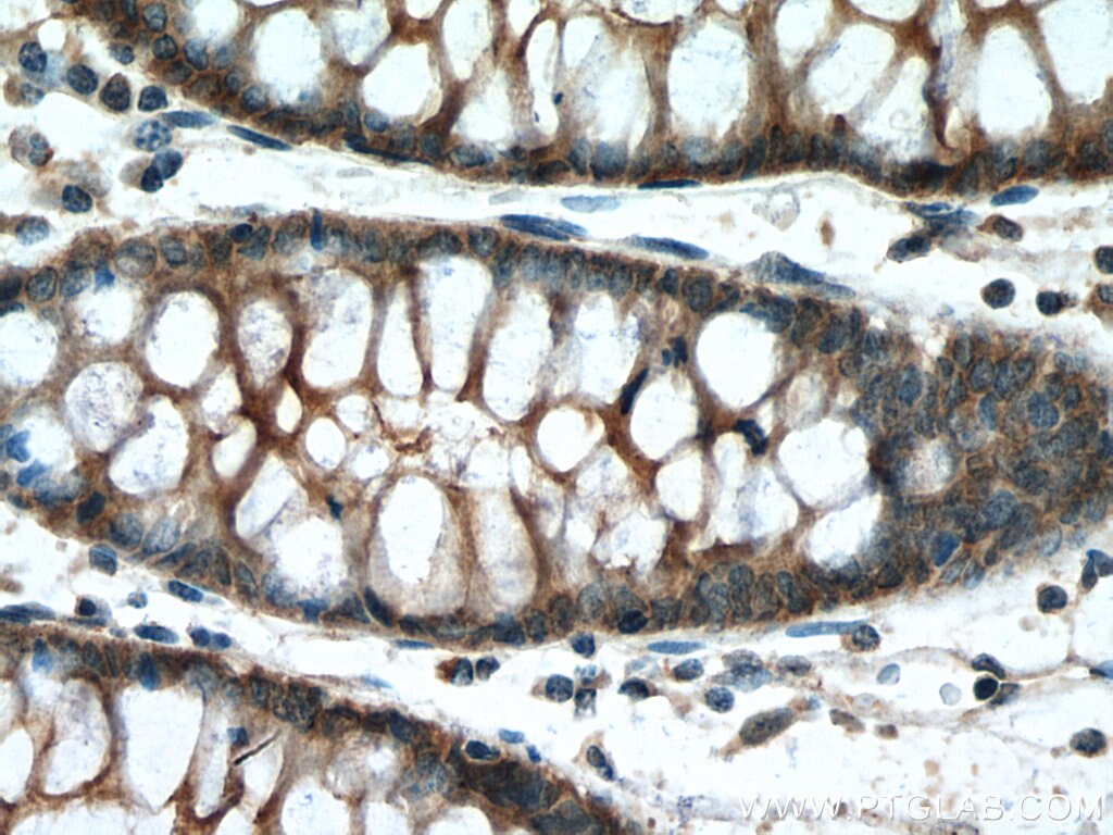 Immunohistochemistry (IHC) staining of human colon cancer tissue using Kindlin 1 Polyclonal antibody (22215-1-AP)