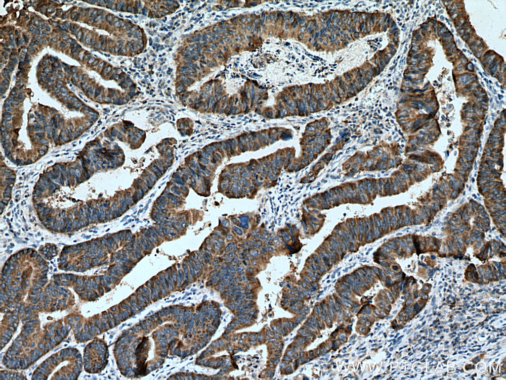 Immunohistochemistry (IHC) staining of human colon cancer tissue using Kindlin 1 Polyclonal antibody (22215-1-AP)