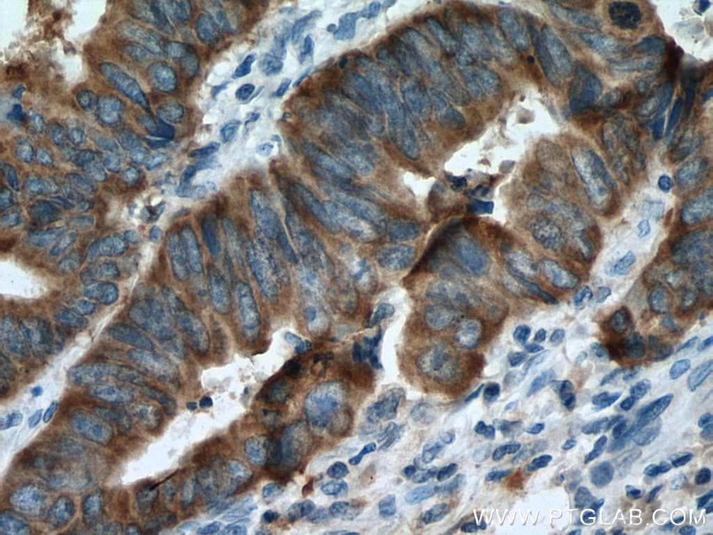 Immunohistochemistry (IHC) staining of human colon cancer tissue using Kindlin 1 Polyclonal antibody (22215-1-AP)