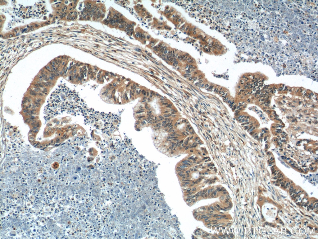 Immunohistochemistry (IHC) staining of human pancreas cancer tissue using Kindlin 1 Polyclonal antibody (22215-1-AP)