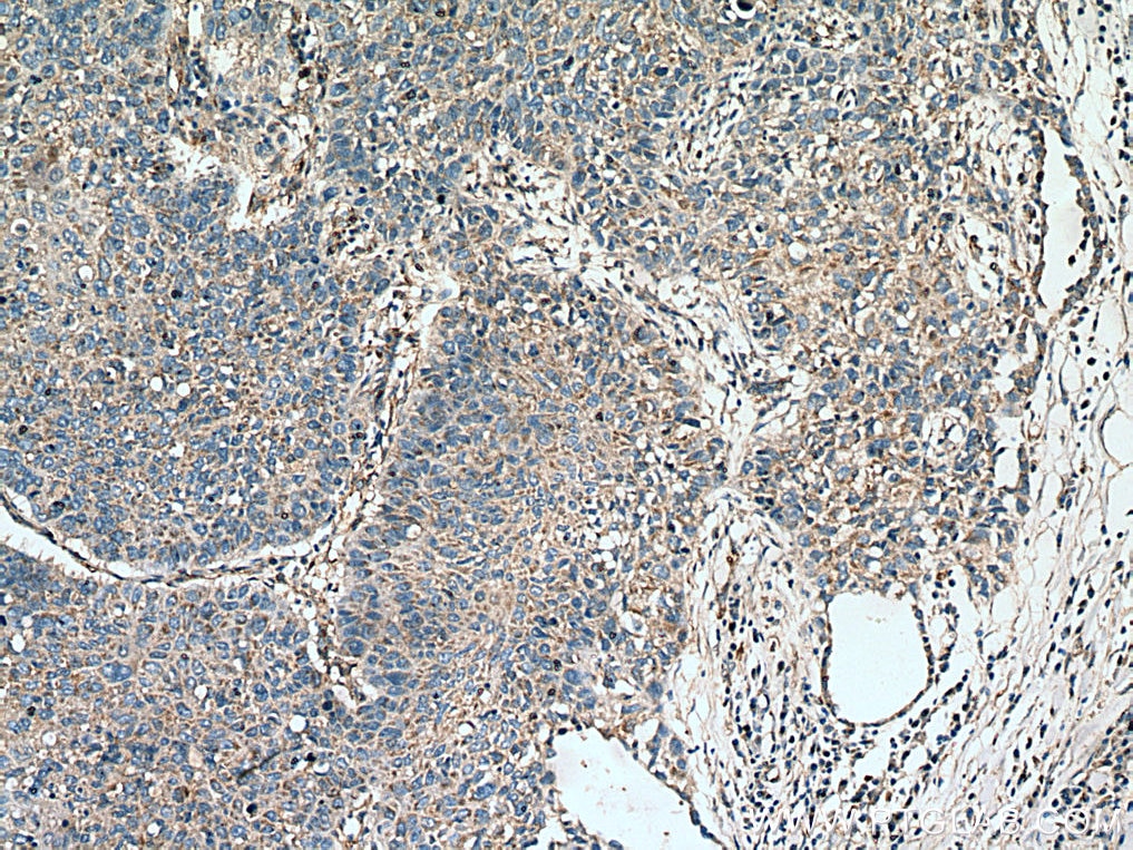 Immunohistochemistry (IHC) staining of human lung cancer tissue using Kindlin 2 Polyclonal antibody (11453-1-AP)