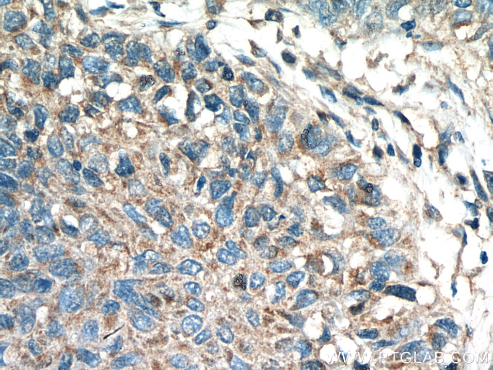 Immunohistochemistry (IHC) staining of human lung cancer tissue using Kindlin 2 Polyclonal antibody (11453-1-AP)
