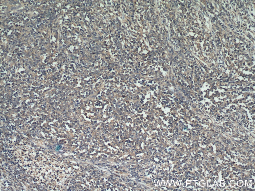 Immunohistochemistry (IHC) staining of human lymphoma tissue using Kindlin 3 Polyclonal antibody (18131-1-AP)