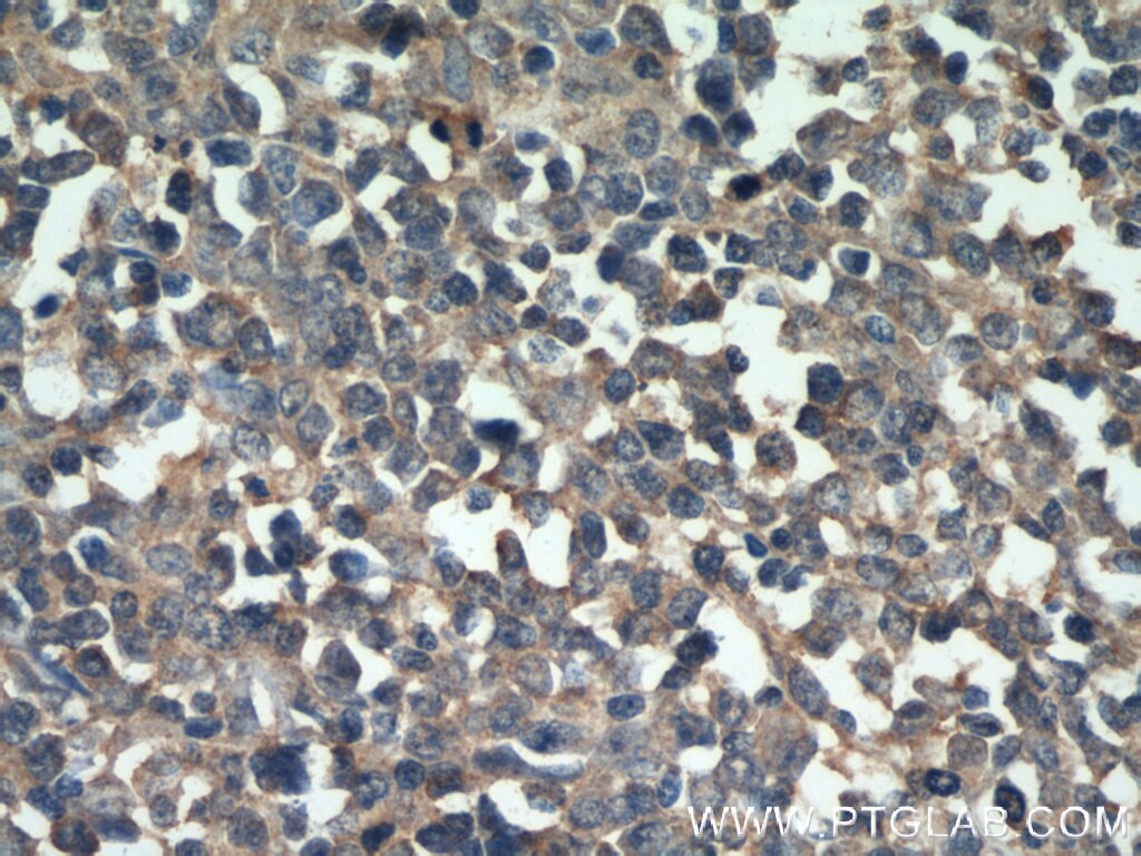 Immunohistochemistry (IHC) staining of human lymphoma tissue using Kindlin 3 Polyclonal antibody (18131-1-AP)