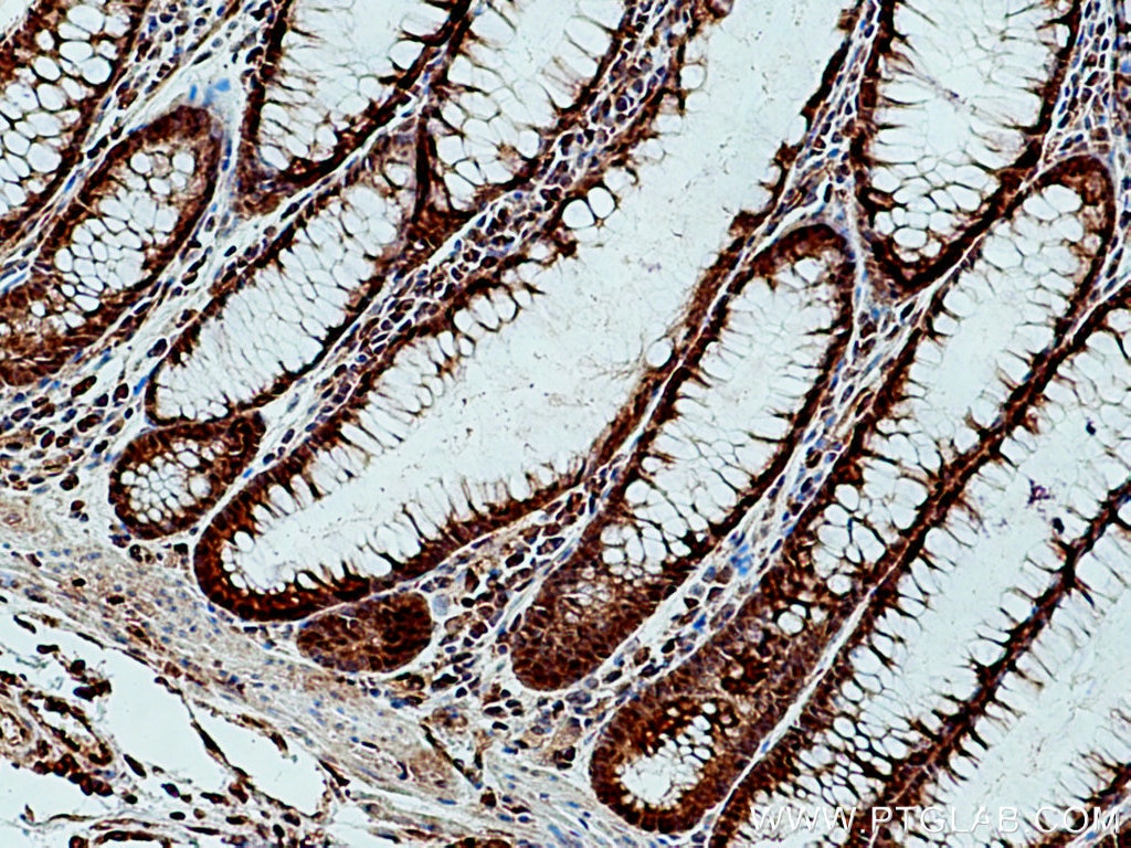 Immunohistochemistry (IHC) staining of human colon cancer tissue using FES Polyclonal antibody (28194-1-AP)