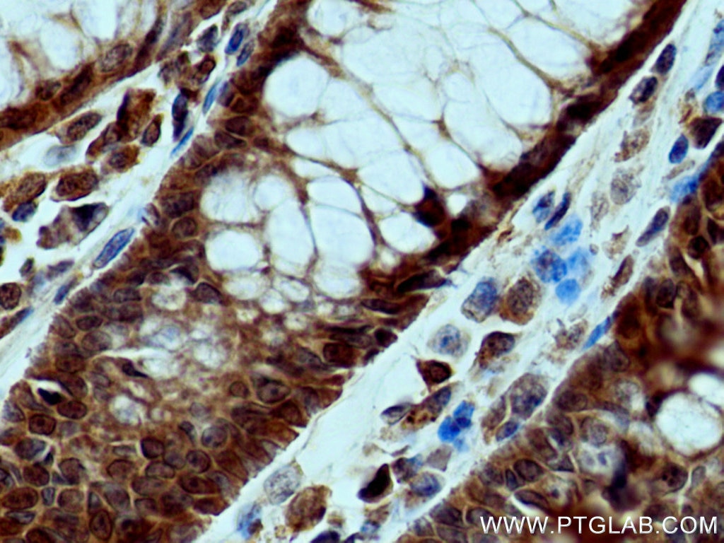 Immunohistochemistry (IHC) staining of human colon cancer tissue using FES Polyclonal antibody (28194-1-AP)