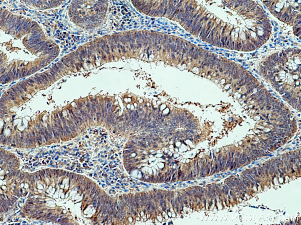 Immunohistochemistry (IHC) staining of human colon cancer tissue using FES Polyclonal antibody (28194-1-AP)