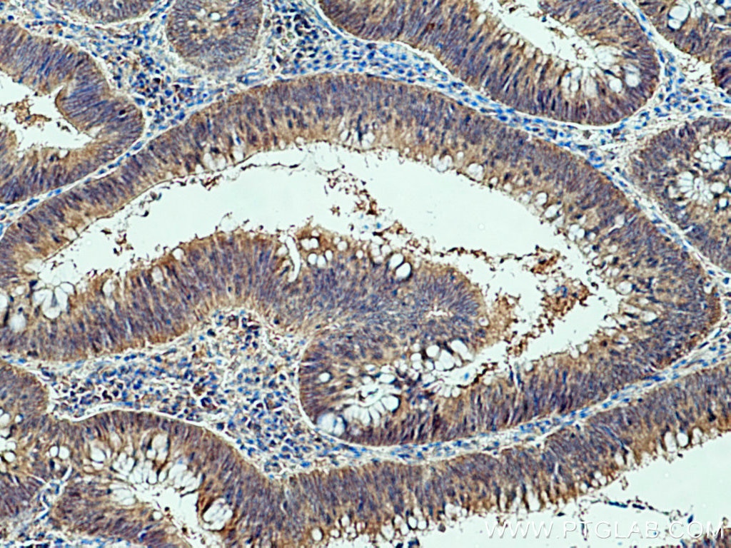 IHC staining of human colon cancer using 28194-1-AP