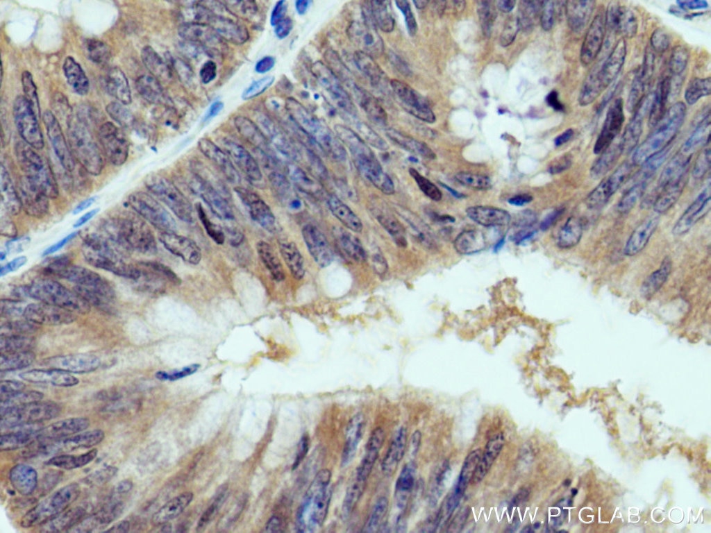 Immunohistochemistry (IHC) staining of human colon cancer tissue using FES Polyclonal antibody (28194-1-AP)