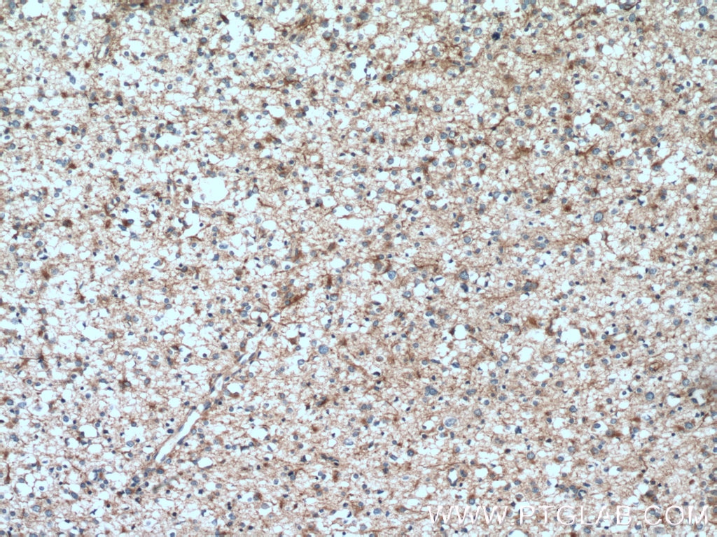 Immunohistochemistry (IHC) staining of human gliomas tissue using FEZ1 Polyclonal antibody (12100-1-AP)