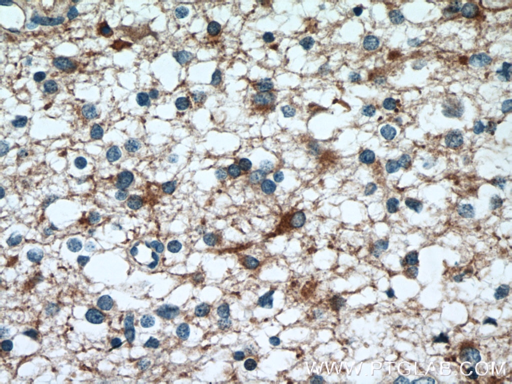 IHC staining of human gliomas using 12100-1-AP