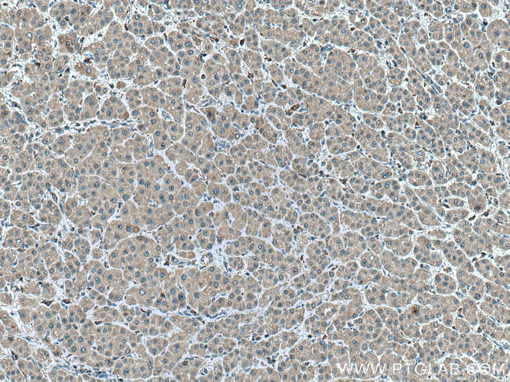 Immunohistochemistry (IHC) staining of human liver cancer tissue using FFAR3 Monoclonal antibody (66811-1-Ig)