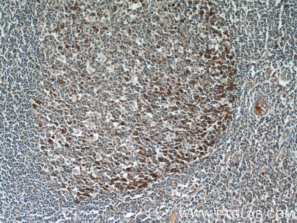 Immunohistochemistry (IHC) staining of human tonsillitis tissue using FGD2 Polyclonal antibody (12187-1-AP)
