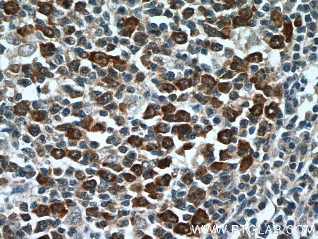 Immunohistochemistry (IHC) staining of human tonsillitis tissue using FGD2 Polyclonal antibody (12187-1-AP)