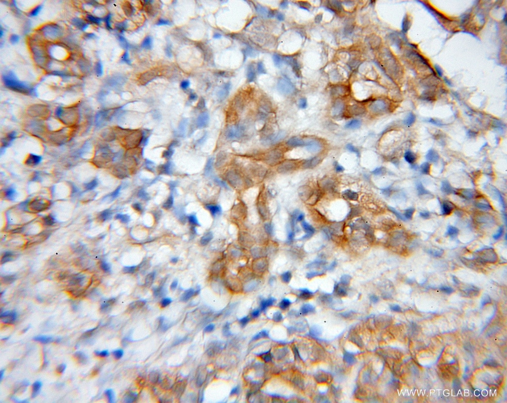 Immunohistochemistry (IHC) staining of human pancreas cancer tissue using FGD2 Polyclonal antibody (12187-1-AP)