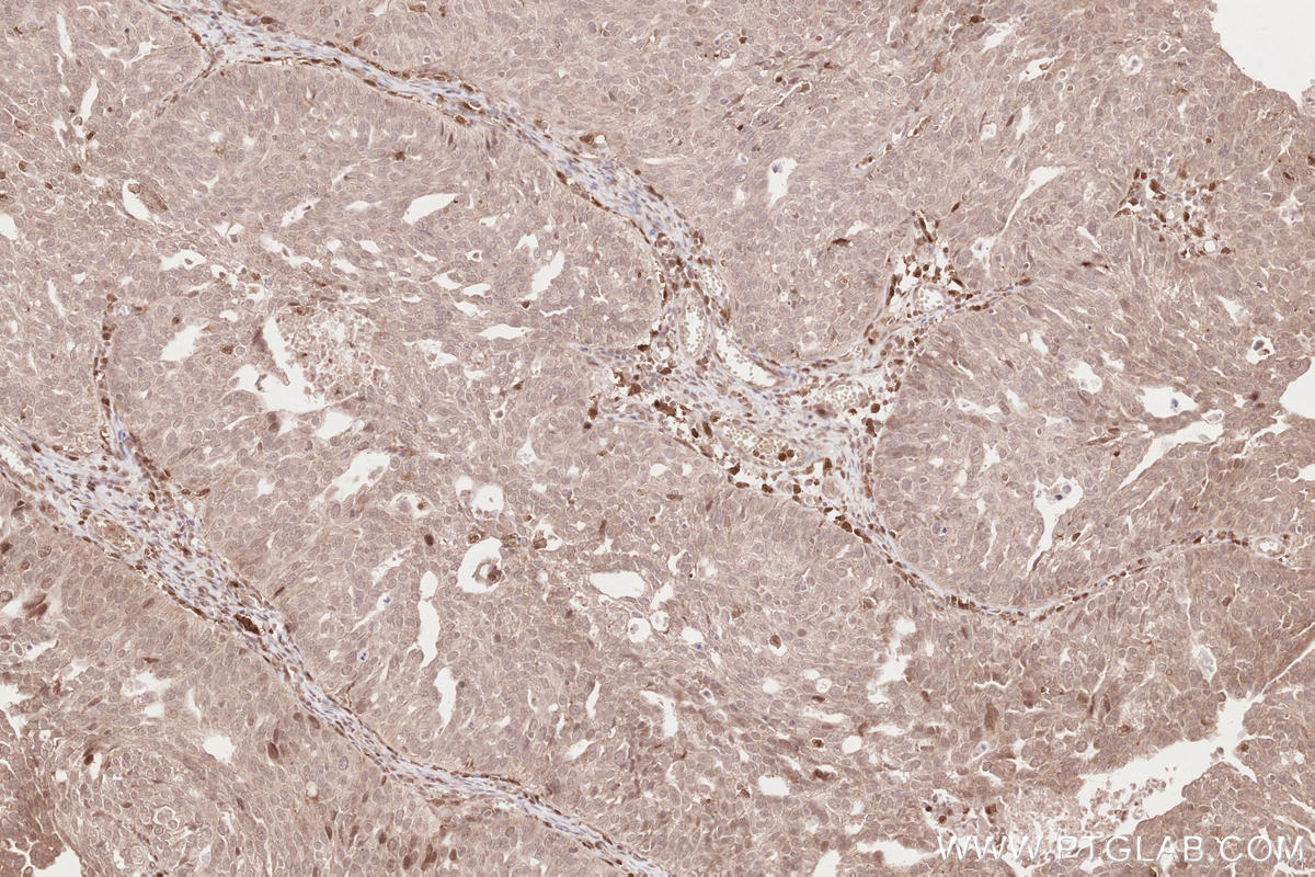 Immunohistochemistry (IHC) staining of human ovary cancer tissue using FGD2 Polyclonal antibody (27068-1-AP)