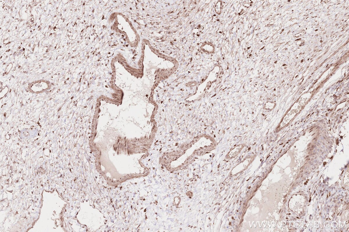 Immunohistochemistry (IHC) staining of human ovary cancer tissue using FGD2 Polyclonal antibody (27068-1-AP)