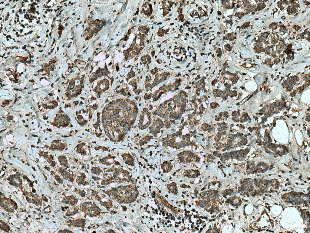 Immunohistochemistry (IHC) staining of human breast cancer tissue using FGD5 Polyclonal antibody (20910-1-AP)
