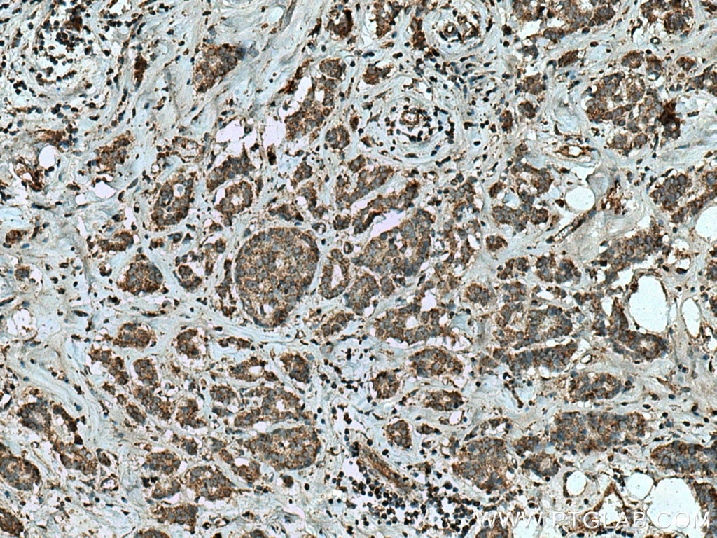 IHC staining of human breast cancer using 20910-1-AP