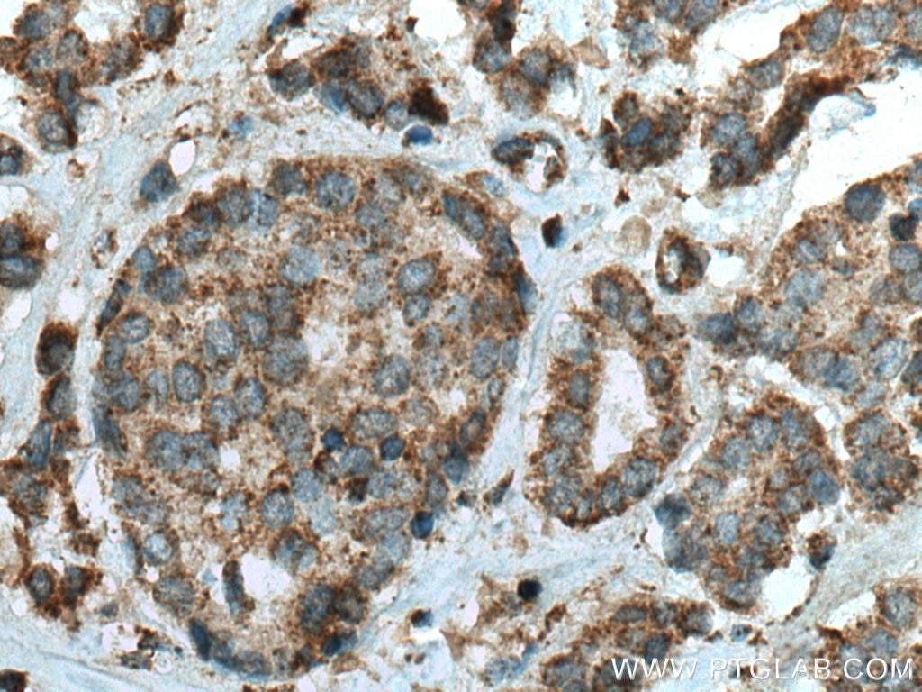 Immunohistochemistry (IHC) staining of human breast cancer tissue using FGD5 Polyclonal antibody (20910-1-AP)