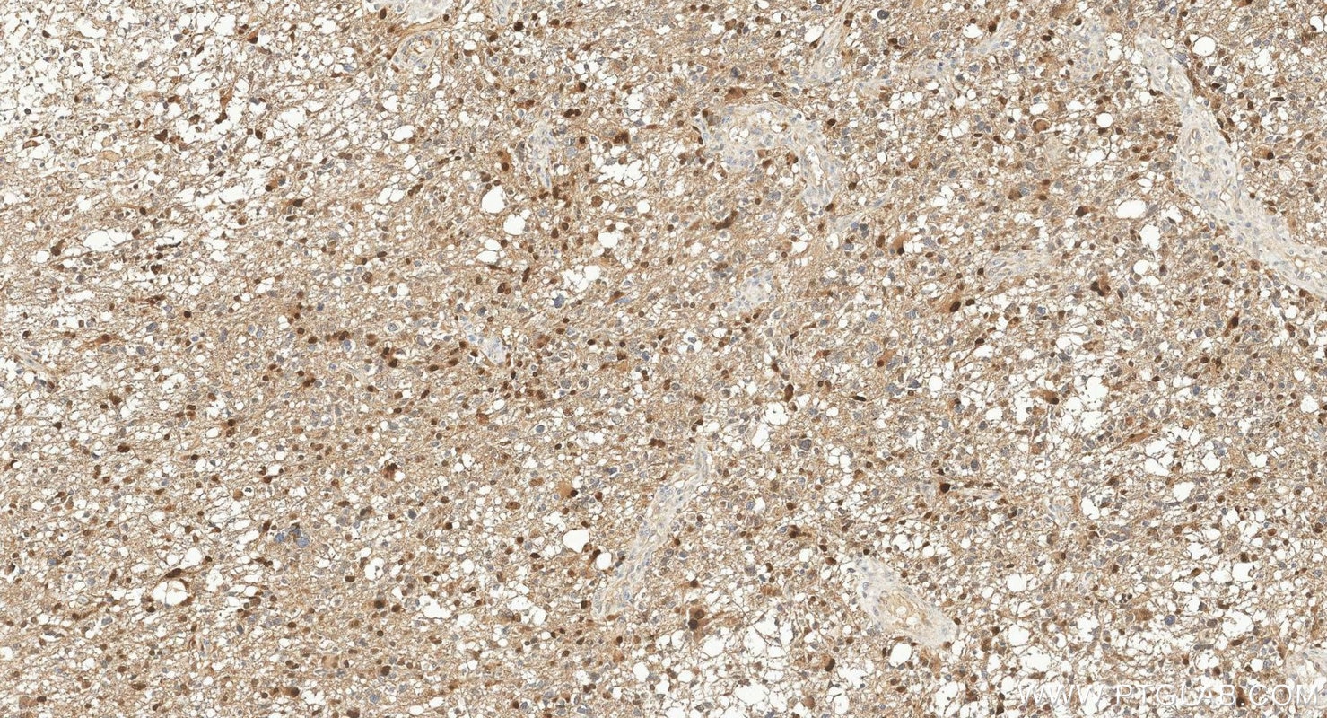 Immunohistochemistry (IHC) staining of human gliomas tissue using FGF2 Polyclonal antibody (30333-1-AP)