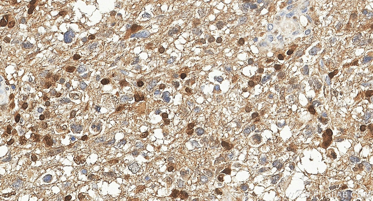 Immunohistochemistry (IHC) staining of human gliomas tissue using FGF2 Polyclonal antibody (30333-1-AP)