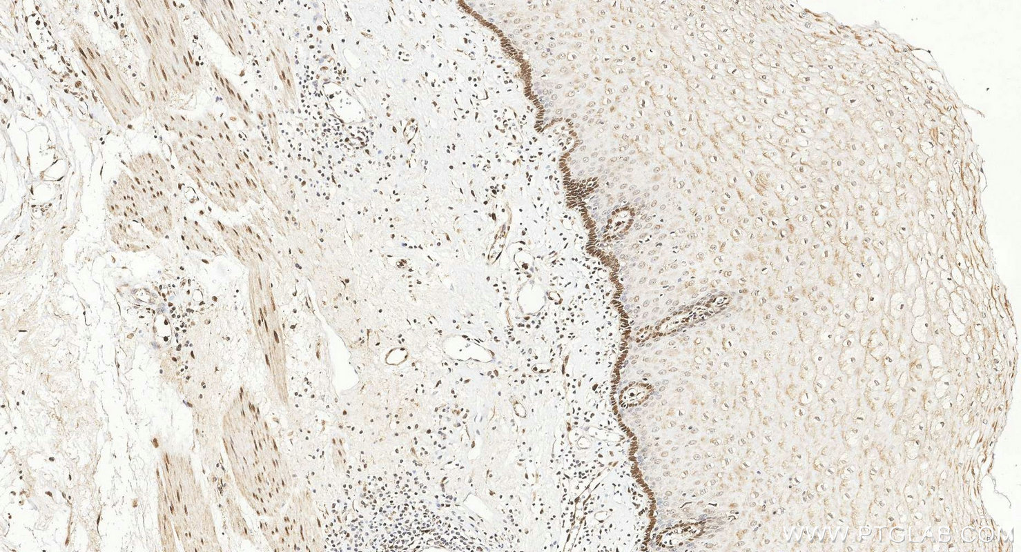 Immunohistochemistry (IHC) staining of human oesophagus cancer tissue using FGF2 Polyclonal antibody (30333-1-AP)