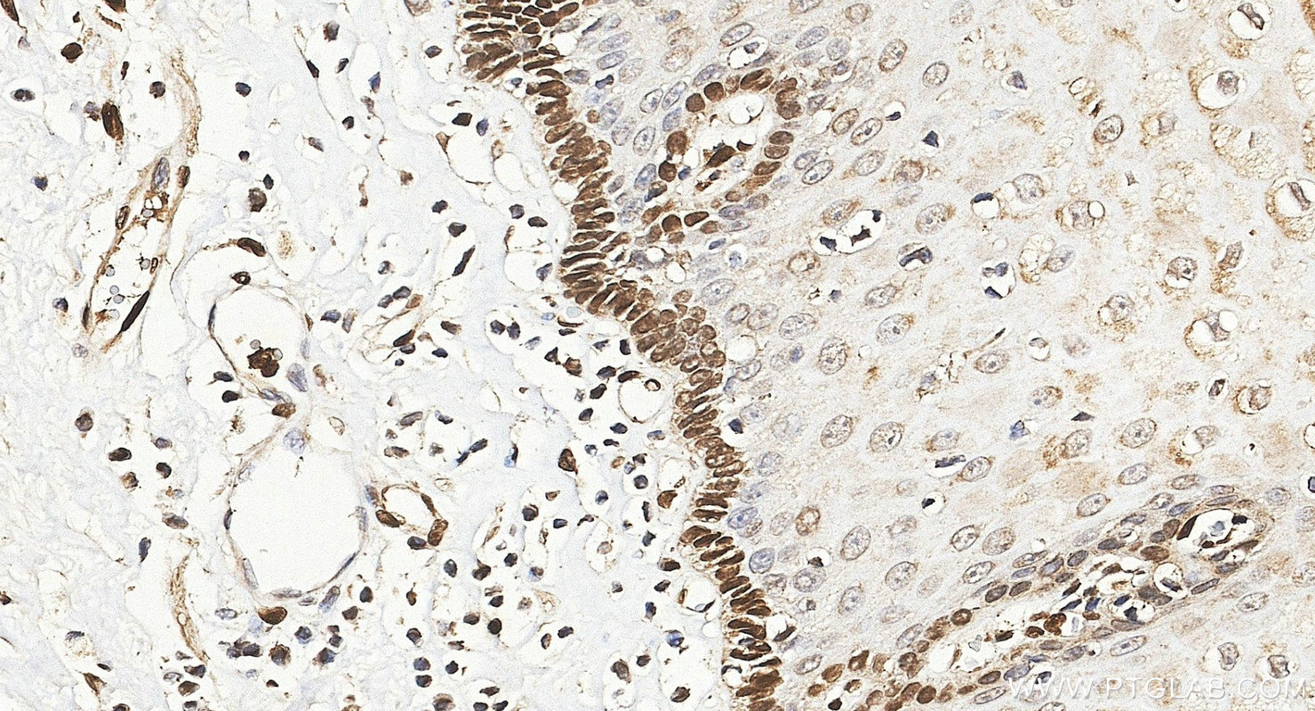 Immunohistochemistry (IHC) staining of human oesophagus cancer tissue using FGF2 Polyclonal antibody (30333-1-AP)