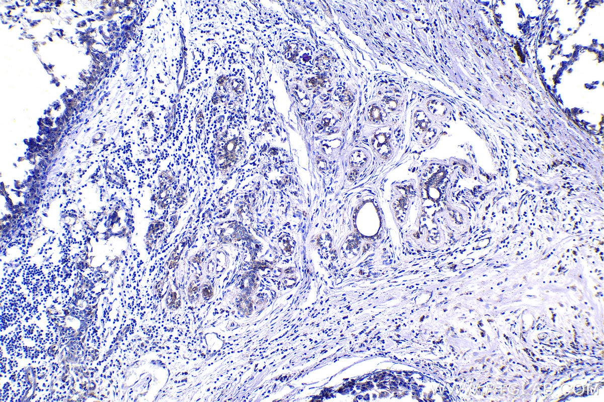 Immunohistochemistry (IHC) staining of human breast cancer tissue using FGF1 Polyclonal antibody (17400-1-AP)