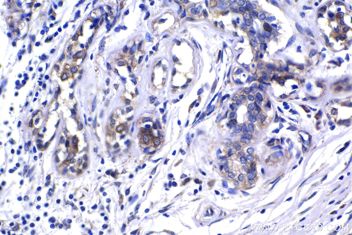 Immunohistochemistry (IHC) staining of human breast cancer tissue using FGF1 Polyclonal antibody (17400-1-AP)