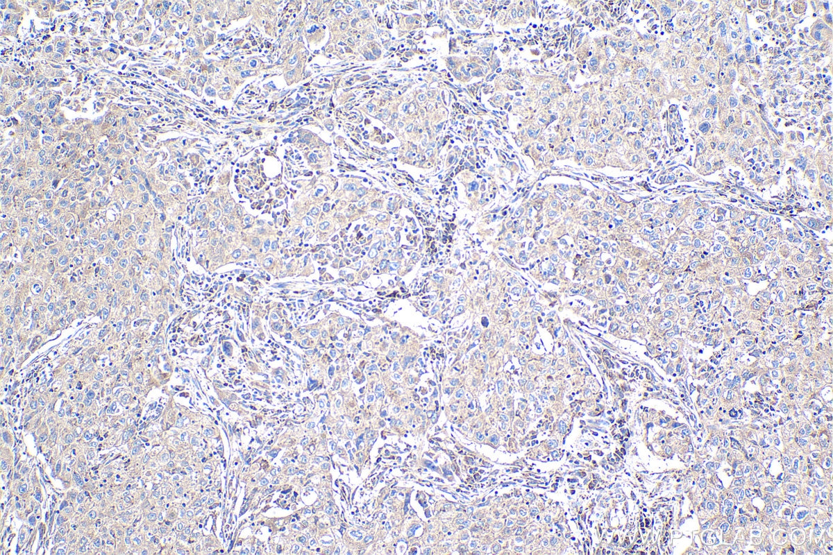 Immunohistochemistry (IHC) staining of human lung cancer tissue using FGF1 Polyclonal antibody (17400-1-AP)