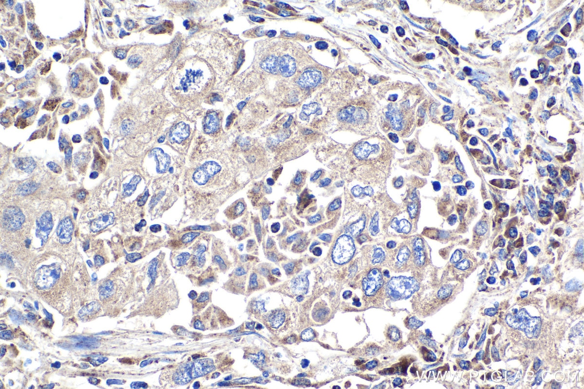 Immunohistochemistry (IHC) staining of human lung cancer tissue using FGF1 Polyclonal antibody (17400-1-AP)