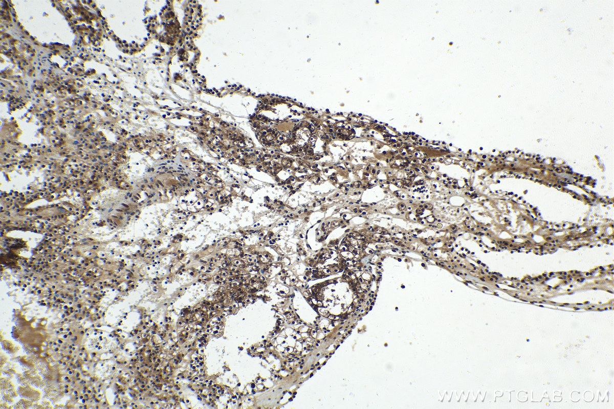 Immunohistochemistry (IHC) staining of human renal cell carcinoma tissue using FGF-2 Polyclonal antibody (11234-1-AP)