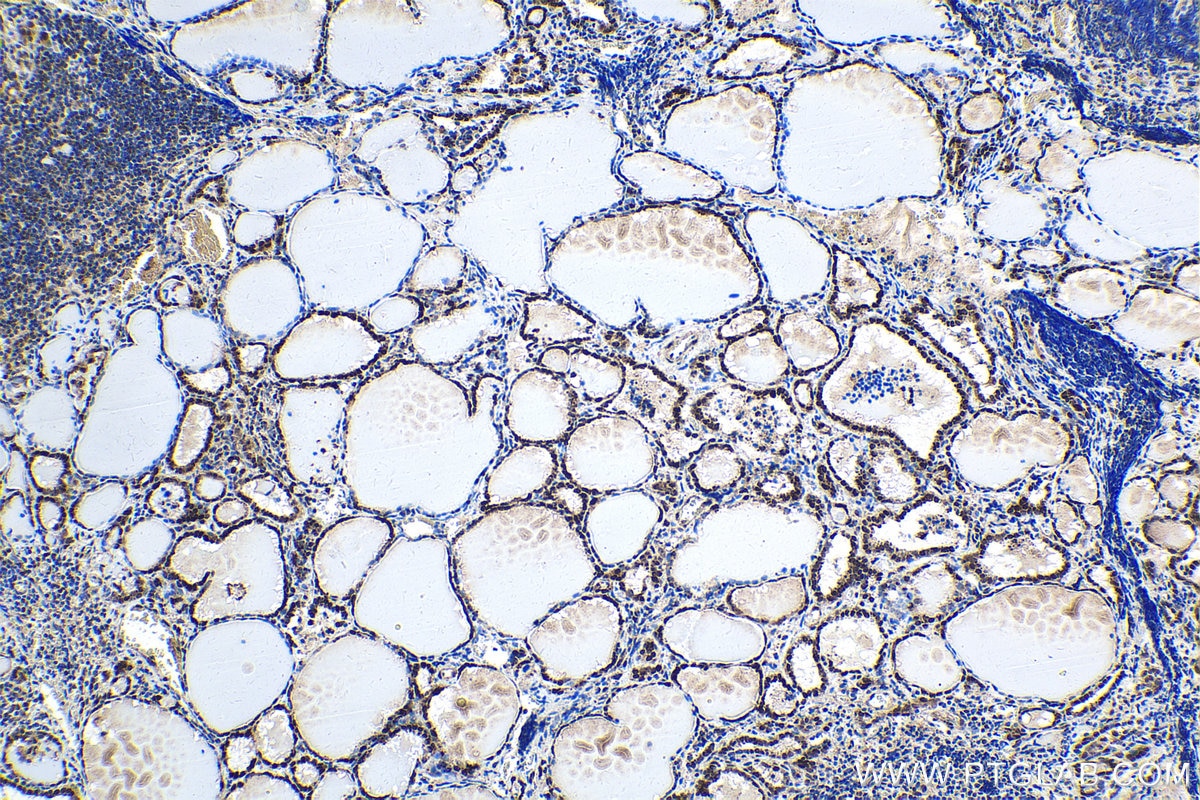 Immunohistochemistry (IHC) staining of human thyroid cancer tissue using FGF-2 Polyclonal antibody (11234-1-AP)