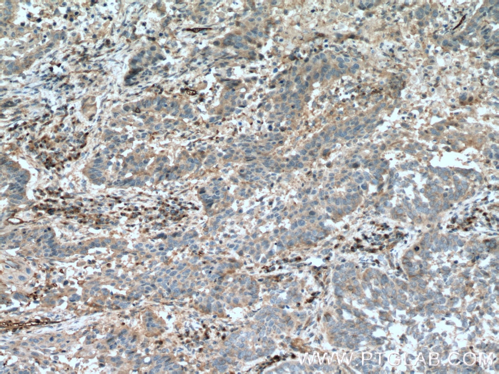 Immunohistochemistry (IHC) staining of human lung cancer tissue using FGF21 Polyclonal antibody (26272-1-AP)