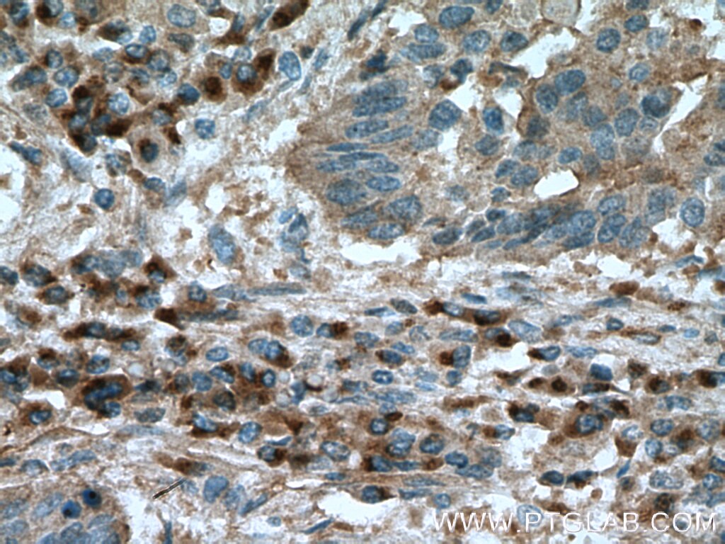 Immunohistochemistry (IHC) staining of human lung cancer tissue using FGF21 Polyclonal antibody (26272-1-AP)