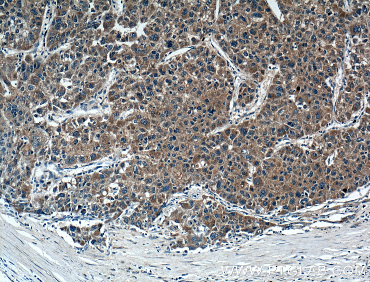 Immunohistochemistry (IHC) staining of human liver cancer tissue using FGF3 Polyclonal antibody (27100-1-AP)