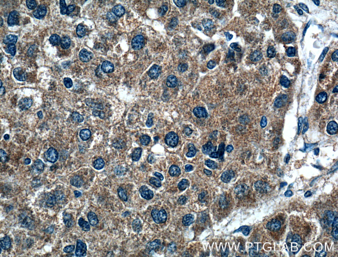 Immunohistochemistry (IHC) staining of human liver cancer tissue using FGF3 Polyclonal antibody (27100-1-AP)