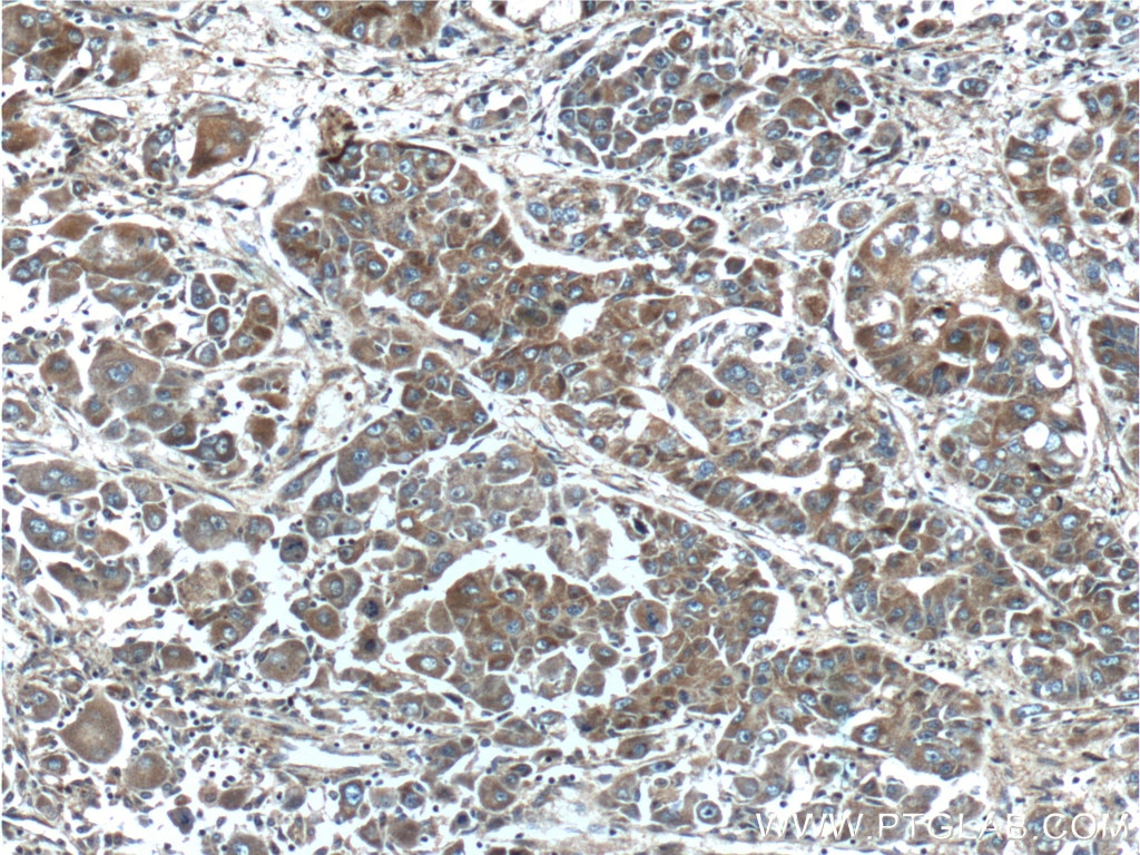 Immunohistochemistry (IHC) staining of human liver cancer tissue using FGF3-Specific Polyclonal antibody (16874-1-AP)