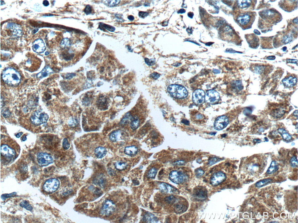 Immunohistochemistry (IHC) staining of human liver cancer tissue using FGF3-Specific Polyclonal antibody (16874-1-AP)