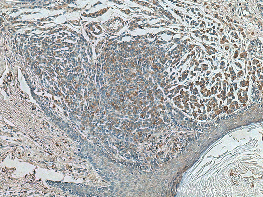 Immunohistochemistry (IHC) staining of human malignant melanoma tissue using FGF5 Polyclonal antibody (18171-1-AP)