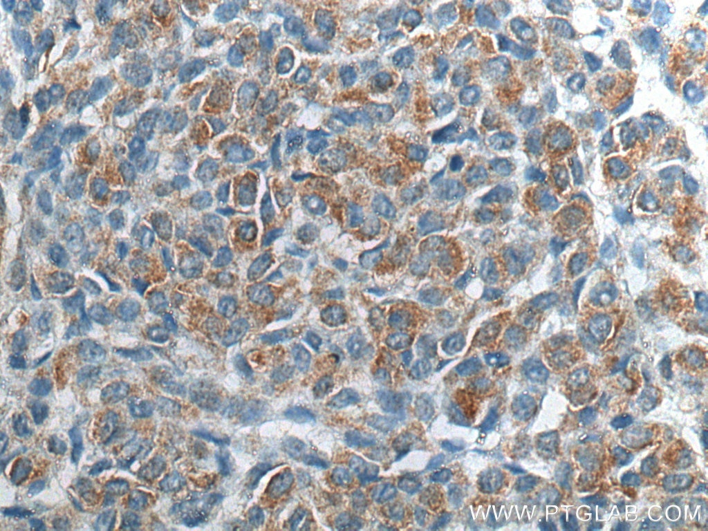 Immunohistochemistry (IHC) staining of human malignant melanoma tissue using FGF5 Polyclonal antibody (18171-1-AP)