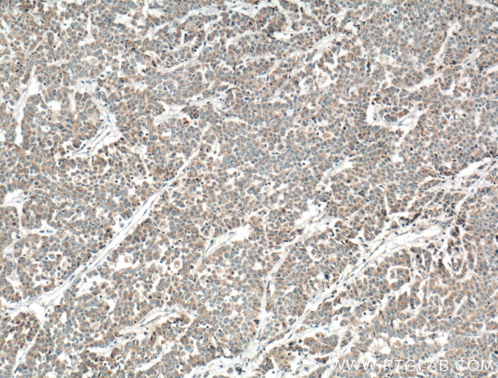 IHC staining of human colon cancer using 26554-1-AP