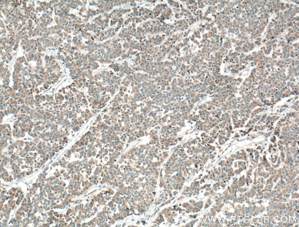 Immunohistochemistry (IHC) staining of human colon cancer tissue using FGF9 Polyclonal antibody (26554-1-AP)