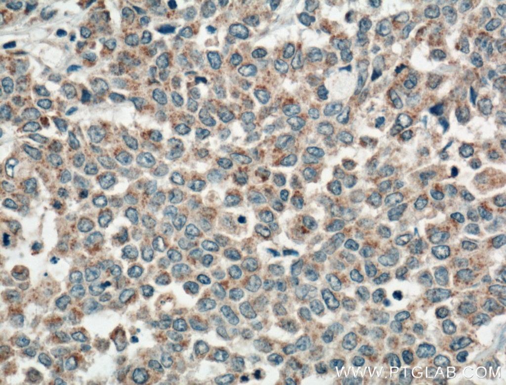 Immunohistochemistry (IHC) staining of human colon cancer tissue using FGF9 Polyclonal antibody (26554-1-AP)